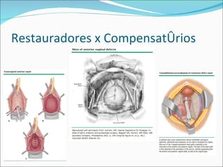 Restauradores x Compensatórios
 