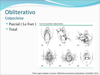 Obliterativo
Colpocleise
 Parcial ( Le Fort )
 Total




                  Pelvic organ prolapse in women: Obliterative procedures (colpocleisis). UpToDate® 2012.
 