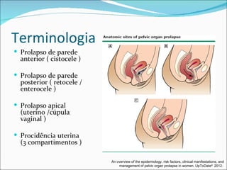 Terminologia
 Prolapso de parede
  anterior ( cistocele )

 Prolapso de parede
  posterior ( retocele /
  enterocele )

 Prolapso apical
  (uterino /cúpula
  vaginal )

 Procidência uterina
  (3 compartimentos )

                           An overview of the epidemiology, risk factors, clinical manifestations, and
                               management of pelvic organ prolapse in women. UpToDate® 2012.
 