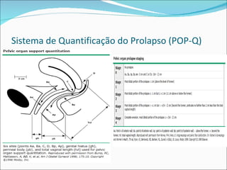 Sistema de Quantificação do Prolapso (POP-Q)
 