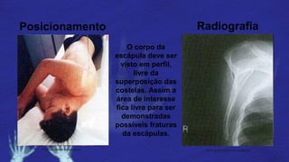 Posicionamento Radiografia
Posição lateral da escápula Radiografia lateral da escápula
O corpo da
escápula deve ser
visto em perfil,
livre da
superposição das
costelas. Assim a
área de interesse
fica livre para ser
demonstradas
possíveis fraturas
da escápulas.
 
