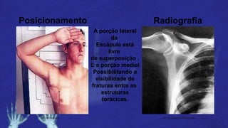 Posicionamento Radiografia
AP de Escápula AP de Escápula Radiografia
A porção lateral
da
Escápula está
livre
de superposição .
E a porção medial
Possibilitando a
visibilidade de
fraturas entre as
estruturas
torácicas.
 