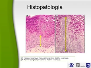 Histopatología
(A) Increased basal layer thickness (noncornified stratified squamous).
(B) Papillary elongation (noncornified stratified squamous).
 