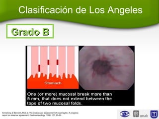 Clasificación de Los Angeles
Grado BGrado B
Armstrong D Bennett JR et al. The endoscopic assessment of esophagitis: A progress
report on observer agreement. Gastroenterology. 1996; 111: 85-92.
 