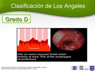 Clasificación de Los Angeles
Grado DGrado D
Armstrong D Bennett JR et al. The endoscopic assessment of esophagitis: A progress
report on observer agreement. Gastroenterology. 1996; 111: 85-92.
 