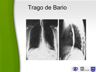 Trago de Bario
 