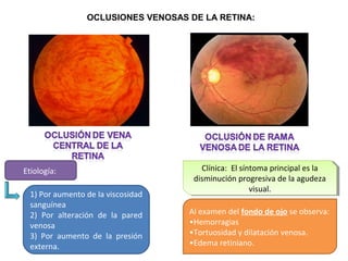 OCLUSIONES VENOSAS DE LA RETINA:

Etiología:
1) Por aumento de la viscosidad
sanguínea
2) Por alteración de la pared
venosa
3) Por aumento de la presión
externa.

Clínica: El síntoma principal es la
Clínica: El síntoma principal es la
disminución progresiva de la agudeza
disminución progresiva de la agudeza
visual.
visual.
Al examen del fondo de ojo se observa:
•Hemorragias
•Tortuosidad y dilatación venosa.
•Edema retiniano.

 