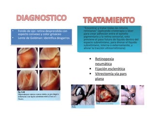 •
•

Fondo de ojo: retina desprendida con
aspecto convexo y color grisáceo
Lente de Goldman: identifica desgarros

•• “Encontrar yytratar todas las roturas
“Encontrar tratar todas las roturas

retinianas” (aplicando crioterapia ooláser
retinianas” (aplicando crioterapia láser
para crear adhesión entre el epitelio
para crear adhesión entre el epitelio
pigmentario yyla retina sensorial, esto
pigmentario la retina sensorial, esto
previene el paso futuro de líquido dentro del
previene el paso futuro de líquido dentro del
espacio subretiniano, para drenar el líquido
espacio subretiniano, para drenar el líquido
subretiniano, interna ooexternamente, yy
subretiniano, interna externamente,
aliviar la tracción vitreorretiniana)
aliviar la tracción vitreorretiniana)

•
•
•
 

Retinopexia
neumática
Fijación esclerótica
Vitrectomía vía pars
plana

 