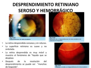 DESPRENDIMIENTO RETINIANO 
SEROSO Y HEMORRÁGICO

•
•
•

•

La retina desprendida convexa y sin roturas.
La superficie retiniana es suave y no
ondulada.
La retina desprendida es muy móvil y
muestra el fenómeno de "liquido que se
desplaza
Después
de
la
resolución
del
desprendimiento se puede ver "manchas
de leopardo".

 
