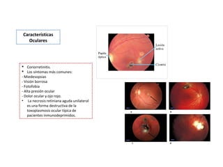 Características 
Oculares

 Coriorretinitis.
 Los síntomas más comunes:
- Miedesopsias
- Visión borrosa
- Fotofobia
- Alta presión ocular
- Dolor ocular y ojo rojo.
• La necrosis retiniana aguda unilateral
es una forma destructiva de la
toxoplasmosis ocular típica de
pacientes inmunodeprimidos.

 