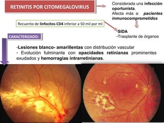 RETINITIS POR CITOMEGALOVIRUS
RETINITIS POR CITOMEGALOVIRUS

Considerada una infección
oportunista.
Afecta  más  a:    pacientes
inmunocomprometidos

Recuento de linfocitos CD4 inferior a 50 mil por ml
CARACTERIZADO:
CARACTERIZADO:

-SIDA
-Trasplante de órganos

-Lesiones blanco- amarillentas con distribución vascular
-  Evolución  fulminante  con  opacidades retinianas  prominentes 
exudados y hemorragias intrarretinianas.

 