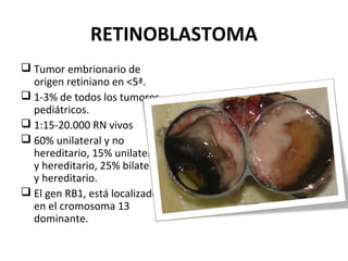 RETINOBLASTOMA
 Tumor embrionario de
origen retiniano en <5ª.
 1-3% de todos los tumores
pediátricos.
 1:15-20.000 RN vivos
 60% unilateral y no
hereditario, 15% unilateral
y hereditario, 25% bilateral
y hereditario.
 El gen RB1, está localizado
en el cromosoma 13
dominante.

 