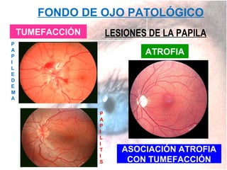 FONDO DE OJO PATOLÓGICO
LESIONES DE LA PAPILA

TUMEFACCIÓN
P
A
P
I
L
E
D
E
M
A

ATROFIA

P
A
P
I
L
I
T
I
S

ASOCIACIÓN ATROFIA
CON TUMEFACCIÓN

 