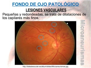 FONDO DE OJO PATOLÓGICO
LESIONES VASCULARES
Pequeñas y redondeadas, se trata de dilataciones de
los capilares más finos.

http://diabetesocular.es/album/slides/Microaneurismas.jpg

 