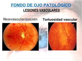 FONDO DE OJO PATOLÓGICO
LESIONES VASCULARES
Tortuosidad vascular

 