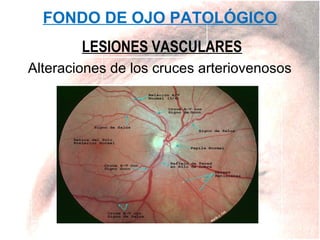 FONDO DE OJO PATOLÓGICO
LESIONES VASCULARES
Alteraciones de los cruces arteriovenosos

 