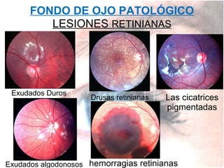 FONDO DE OJO PATOLÓGICO
LESIONES RETINIANAS

Exudados Duros

Drusas retinianas

Las cicatrices
pigmentadas

Exudados algodonosos hemorragias retinianas

 