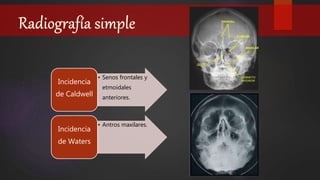 • Senos frontales y
etmoidales
anteriores.
Incidencia
de Caldwell
• Antros maxilares.
Incidencia
de Waters
 