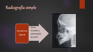 • Senos
frontales y
esfenoidales
de perfil.
Incidencia
lateral
 