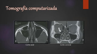Corte axial Corte coronal
 