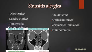 -Diagnostico:
•Cuadro clínico
•Tomografía
Computarizada
-Tratamiento:
•Antihistaminicos
•Corticoides inhalados
•Inmunoterapia
BR. Gabriela Gil
 