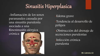 -Inflamación de los senos
paranasales causada por
una sinusitis purulenta
asociada a una
Rinosinusitis alérgica
crónica
•Edema grave
•Tendencia al desarrollo de
pólipos
•Obstrucción del drenaje de
secreciones purulentas
•Infección crónica
purulenta
BR. Gabriela Gil
 