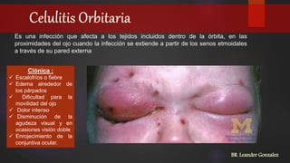 Es una infección que afecta a los tejidos incluidos dentro de la órbita, en las
proximidades del ojo cuando la infección se extiende a partir de los senos etmoidales
a través de su pared externa
Clónica :
 Escalofríos o fiebre
 Edema alrededor de
los párpados
 Dificultad para la
movilidad del ojo
 Dolor intenso
 Disminución de la
agudeza visual y en
ocasiones visión doble
 Enrojecimiento de la
conjuntiva ocular.
BR. Leander Gonzalez
 