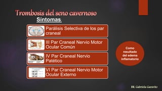 Parálisis Selectiva de los par
craneal
III Par Craneal Nervio Motor
Ocular Común
IV Par Craneal Nervio
Patético
VI Par Craneal Nervio Motor
Ocular Externo
Como
resultado
del edema
inflamatorio
Síntomas:
BR. Gabriela Garavito
 