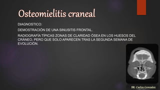 DIAGNOSTICO:
DEMOSTRACIÓN DE UNA SINUSITIS FRONTAL.
RADIOGRAFÍA TÍPICAS ZONAS DE CLARIDAD ÓSEA EN LOS HUESOS DEL
CRÁNEO, PERO QUE SOLO APARECEN TRAS LA SEGUNDA SEMANA DE
EVOLUCIÓN.
BR. Carlos Gonzalez
 