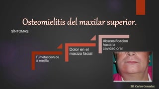 SÍNTOMAS:
Tumefacción de
la mejilla
Dolor en el
macizo facial
Abscesificacion
hacia la
cavidad oral
BR. Carlos Gonzalez
 