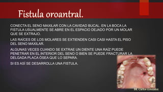 CONECTA EL SENO MAXILAR CON LA CAVIDAD BUCAL. EN LA BOCA LA
FISTULA USUALMENTE SE ABRE EN EL ESPACIO DEJADO POR UN MOLAR
QUE SE EXTRAJO.
LAS RAÍCES DE LOS MOLARES SE EXTIENDEN CASI CASI HASTA EL PISO
DEL SENO MAXILAR.
ALGUNAS VECES CUANDO SE EXTRAE UN DIENTE UNA RAÍZ PUEDE
PENETRAR EN EL INTERIOR DEL SENO O BIEN SE PUEDE FRACTURAR LA
DELGADA PLACA ÓSEA QUE LO SEPARA.
SI ES ASÍ SE DESARROLLA UNA FISTULA.
BR. Carlos Gonzalez
 