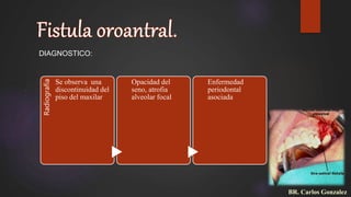 DIAGNOSTICO:
Radiografía
Se observa una
discontinuidad del
piso del maxilar
Opacidad del
seno, atrofia
alveolar focal
Enfermedad
periodontal
asociada
BR. Carlos Gonzalez
 