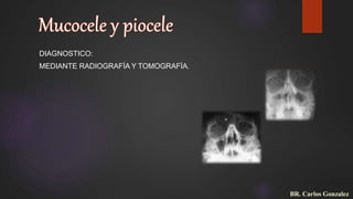 DIAGNOSTICO:
MEDIANTE RADIOGRAFÍA Y TOMOGRAFÍA.
BR. Carlos Gonzalez
 