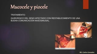 TRATAMIENTO:
QUIRÚRGICO DEL SENO AFECTADO CON RESTABLECIMIENTO DE UNA
BUENA COMUNICACIÓN NASOSINUSAL.
BR. Carlos Gonzalez
 