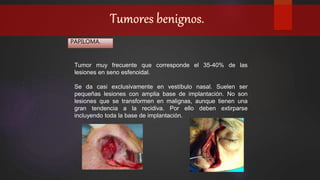 PAPILOMA.
Tumor muy frecuente que corresponde el 35-40% de las
lesiones en seno esfenoidal.
Se da casi exclusivamente en vestíbulo nasal. Suelen ser
pequeñas lesiones con amplia base de implantación. No son
lesiones que se transformen en malignas, aunque tienen una
gran tendencia a la recidiva. Por ello deben extirparse
incluyendo toda la base de implantación.
 