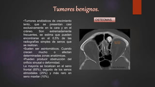 OSTEOMAS.•Tumores endósticos de crecimiento
lento, que se presentan casi
exclusivamente en la cara y en el
cráneo. Son extremadamente
frecuentes, se estima que pueden
encontrarse en el 0,5% de las
radiografías simples de senos que
se realizan.
•Suelen ser asintomáticos. Cuando
crecen mucho o afectan
determinadas zonas anatómicas.
•Pueden producir obstrucción del
orificio sinusal o deformidad.
La mayoría se localizan en el seno
frontal (65%), seguido de los senos
etmoidales (25%) y más raro en
seno maxilar (10%).
 