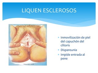  Inmovilización de piel
del capuchón del
clítoris
 Dispareunia
 Impide entrada al
pene
LIQUEN ESCLEROSOS
 