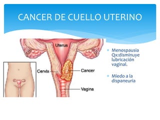  Menospausia
Qx:disminuye
lubricación
vaginal.
 Miedo a la
dispaneuria
CANCER DE CUELLO UTERINO
 