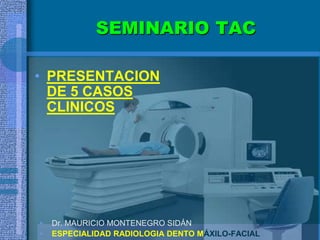 SEMINARIO TAC PRESENTACION DE 5 CASOS CLINICOS Dr. MAURICIO MONTENEGRO SIDÁN ESPECIALIDAD RADIOLOGIA DENTO MÁXILO-FACIAL 