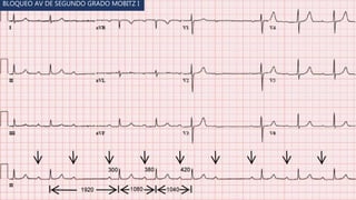 Av Block Visual Comprehensive Overview of Atrioventricular (AV) Block Types and ...