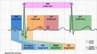 Comprehensive Overview of Atrioventricular (AV) Block Types and ...