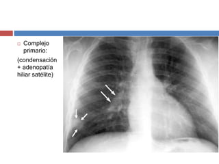  Complejo
primario:
(condensación
+ adenopatía
hiliar satélite)
 