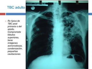 TBC adulto
 Rx típica de
TBC post
primaria o del
adulto.
Compromete
lóbulos
superiores,
tiene
imágenes
acinonodosas,
condensación,
pequeñas
cavitaciones.
 