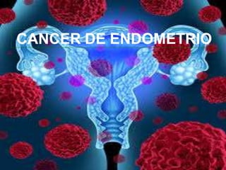 CANCER DE ENDOMETRIO
 