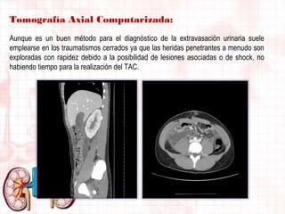 Tomografía Axial Computarizada:
Aunque es un buen método para el diagnóstico de la extravasación urinaria suele
emplearse en los traumatismos cerrados ya que las heridas penetrantes a menudo son
exploradas con rapidez debido a la posibilidad de lesiones asociadas o de shock, no
habiendo tiempo para la realización del TAC.

 
