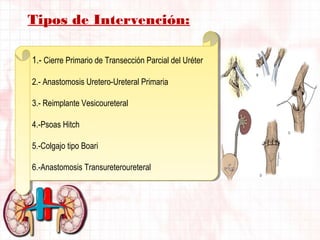 Tipos de Intervención:
1.- Cierre Primario de Transección Parcial del Uréter
2.- Anastomosis Uretero-Ureteral Primaria
3.- Reimplante Vesicoureteral
4.-Psoas Hitch
5.-Colgajo tipo Boari
6.-Anastomosis Transureteroureteral

 
