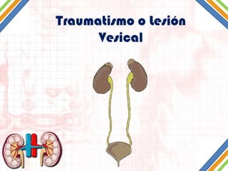 Traumatismo o Lesión
Vesical

 
