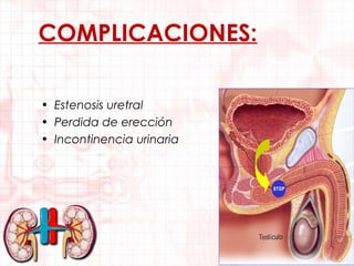 COMPLICACIONES:
• Estenosis uretral
• Perdida de erección
• Incontinencia urinaria

 