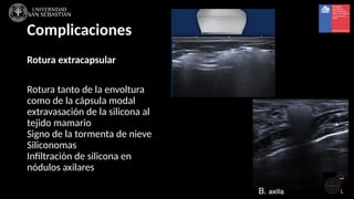 Seminario US mama implante prótesis y complicaciones | PPTX