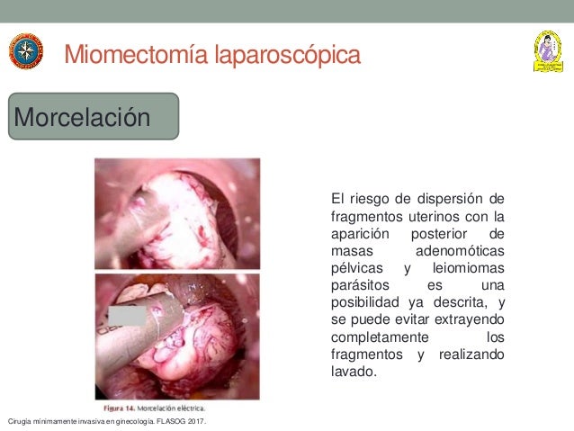 Tecnicas laparoscopicas: histerectomia, miomectomia y reseccion de en…